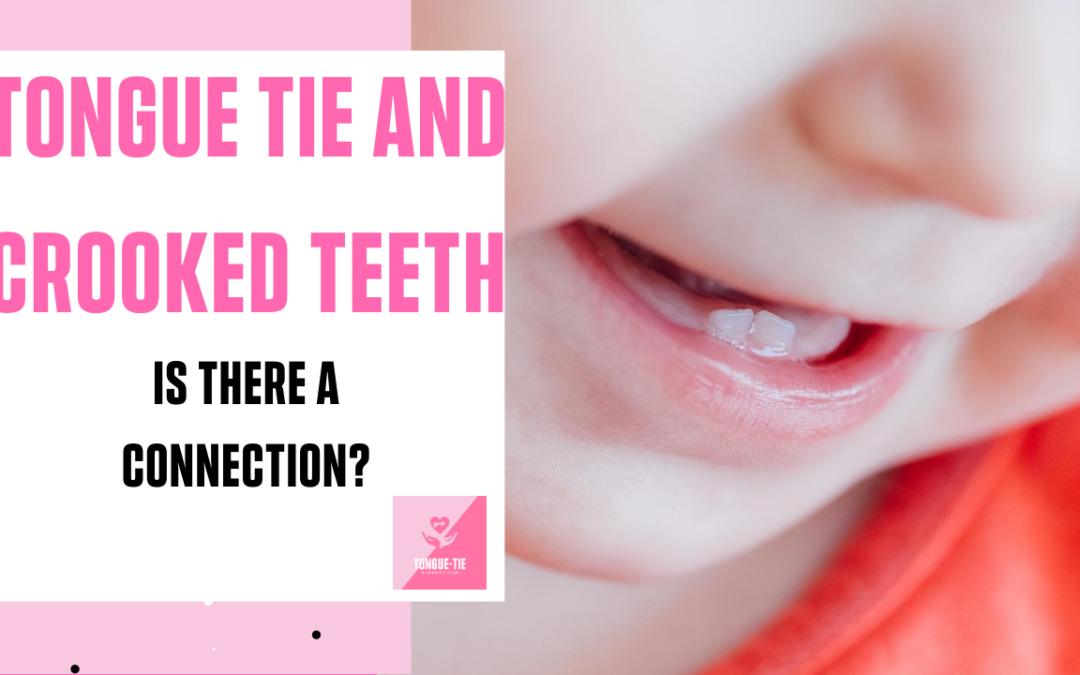 Tongue Tie and Crooked Teeth, is There a Connection?